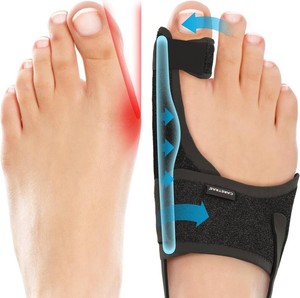 $30 2-Pack Bunion Corrector for Women & Men, Orthopedic Bunion Splint for Hallux Valgus Pain Relief, Big Toe Separator, Adjustable DayNight Support, Comfortable Hammer Toe Straightener